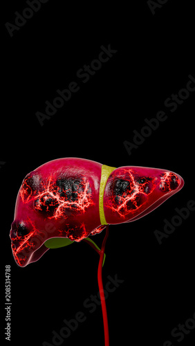 Cancer Cell Growth Inside Fatty Liver Tissue Demonstrating Tumor Development, Blood Vessel Formation, Malignant Expansion, and Human Liver Disease Progression 3D Rendering