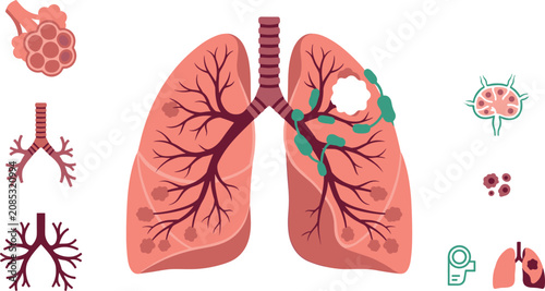 Fotografie Human Lung Anatomy and Respiratory System Disease Vector Illustration Set Featur