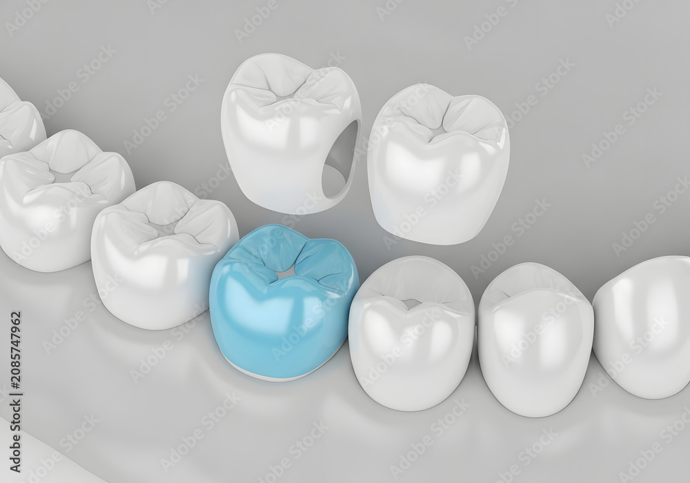 Fototapeta premium Dental crown procedure showing a single blue tooth replacement in a row of white teeth for restorative dentistry
