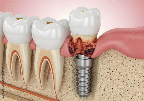 Peri-implantitis inflammation around a dental implant in the jawbone, medical 3d illustration of gum disease issues