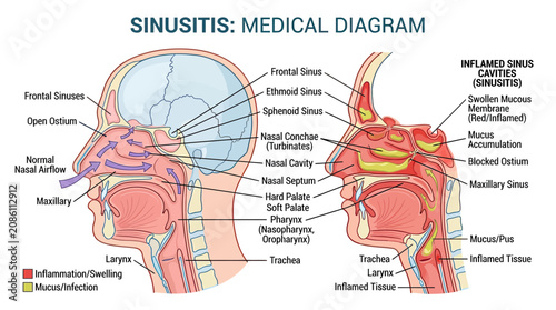 Εκτύπωση καμβά Sinusitis Medical Diagram: Anatomy of Nasal Passages and Inflamed Sinus Cavities