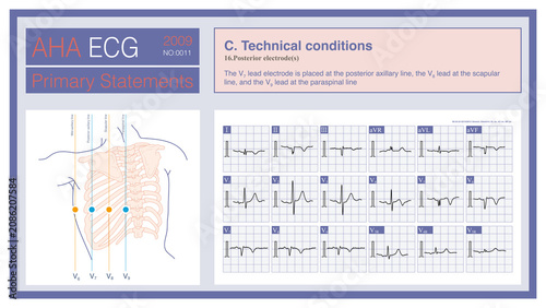 Canvastavla Posterior wall leads are three chest leads—comprising leads V7, V8, and V9—placed on the left side of the back to detect myocardial ischemia of the posterior wall