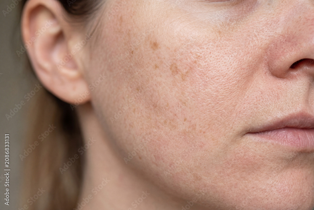 Naklejka premium This close up shows a person's facial skin with mild sun spots and uneven pigmentation. The image captures the texture and tone of the skin under natural light