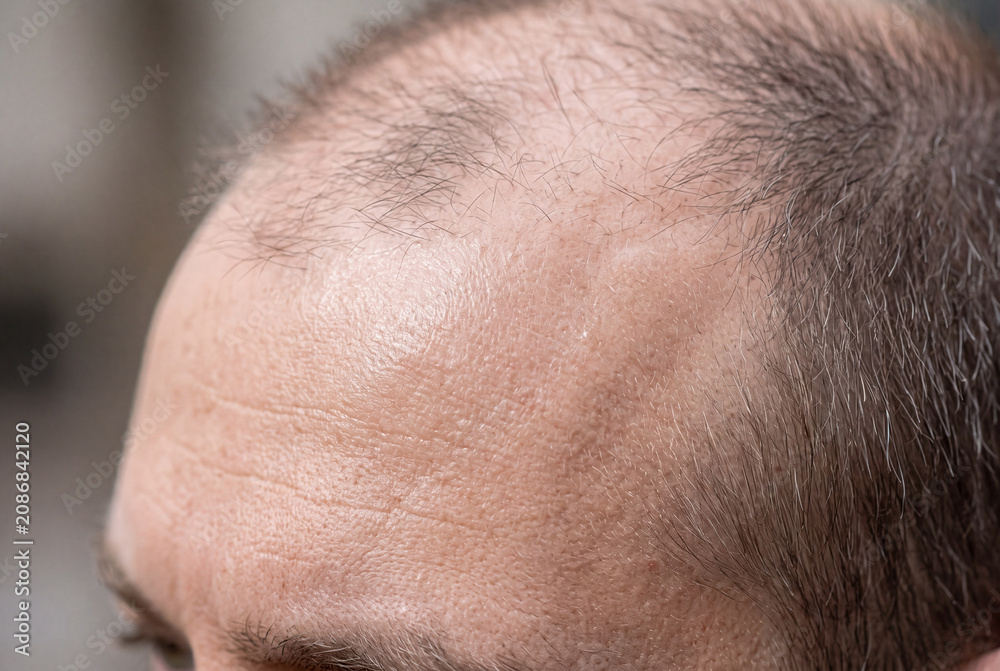 Fototapeta premium Close up view of a frontal hairline showing thinning hair. The scalp appears visible with signs of hair loss in this realistic setting. The texture and details of the hair are clear