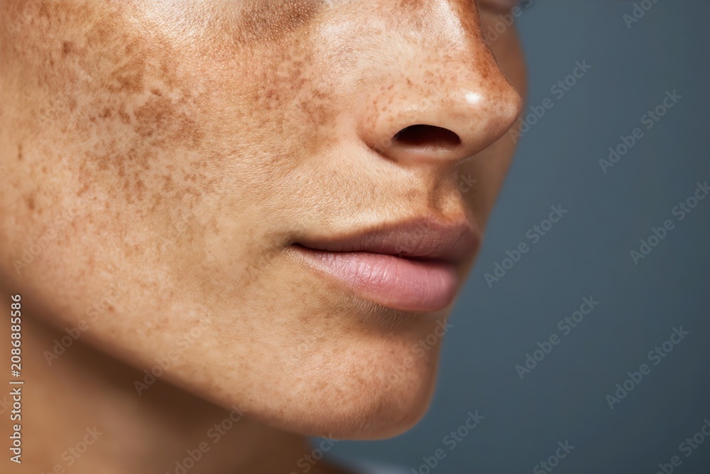 Naklejka premium Moderate Melasma on Upper Cheek Area with Visible Brown Patches