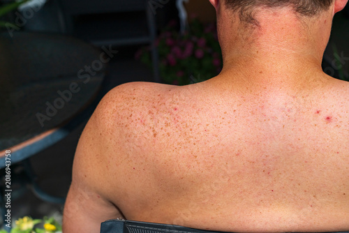 Bild auf Leinwand freckled skin showing natural texture and pigmentation after summer sunshine