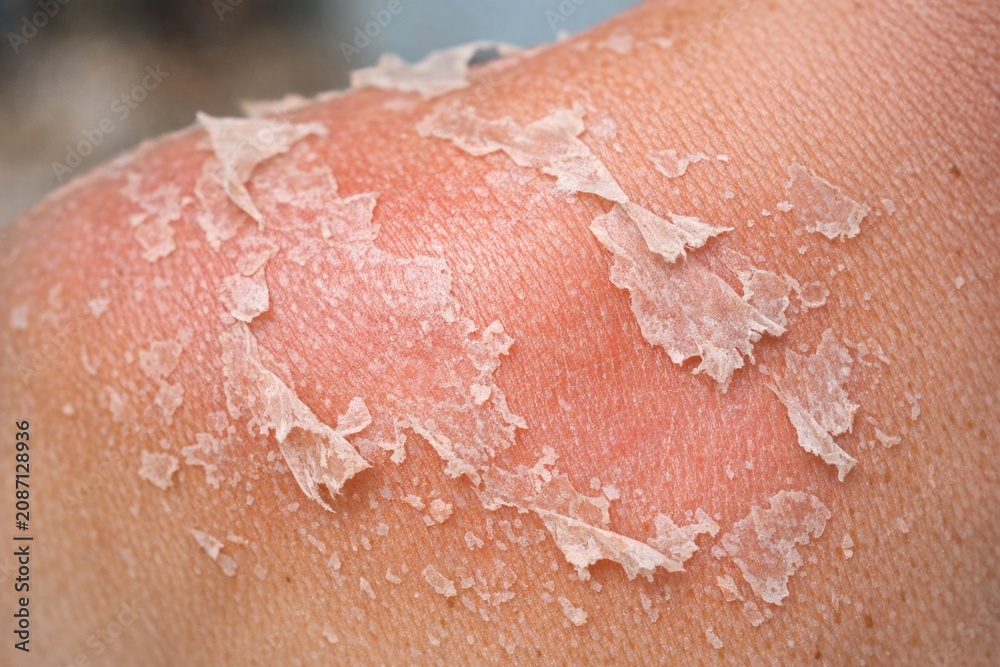 Fototapeta premium A close-up shot of human skin showing vitiligo, a condition characterized by white patches