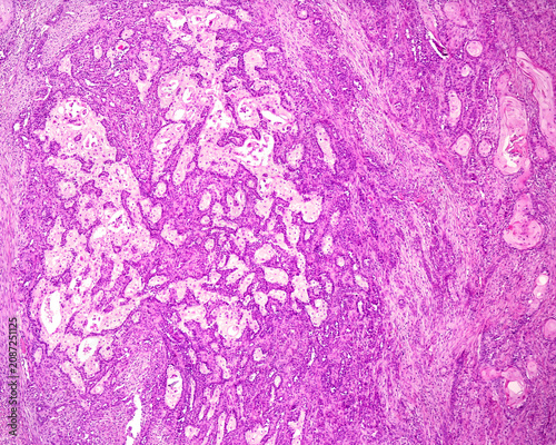 Skin. Squamous cell carcinoma