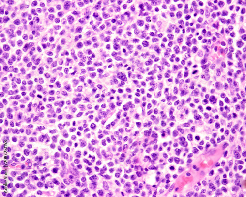 Fotografie Human lymph node. Hodgkin lymphoma