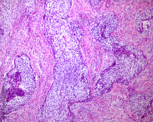 Fotografía Human cervix. Squamous cell carcinoma