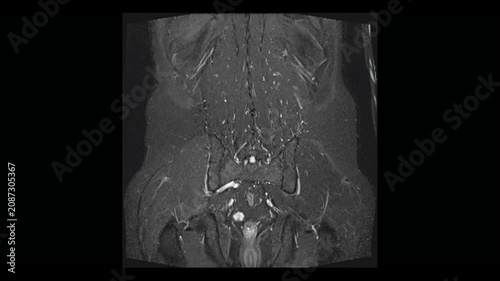  Coronal abdominal MRI scan visualization highlighting kidneys and urinary bladder. Medical animation sequence for internal organs diagnostic and research.