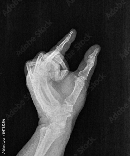 Film xray or radiograph of a hand, thumb and index pinch finger gesture for inch,  this much, or small, short, measurement, tiny, miniscule,  commonly used to describe a mini penis