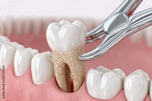 Surgical tooth extraction using metallic dental forceps in mouth