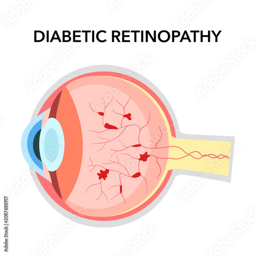 Diabetic retinopathy anatomical poster. Human eye disease, vision loss or blindness. Damaged blood vessels in the retina. Proliferative or nonproliferative eye condition medical vector illustration