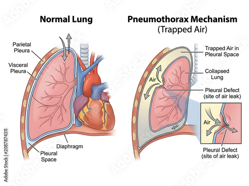 Pneumothorax showing trapped air in collapsed lung diagram isolated on white background