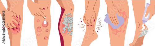 Skin Conditions and Leg Dermatitis Treatment Icon Set with Itching Scratching Rashes Eczema Dry Cracking Heels and Medical Cream Application Vector Illustrations