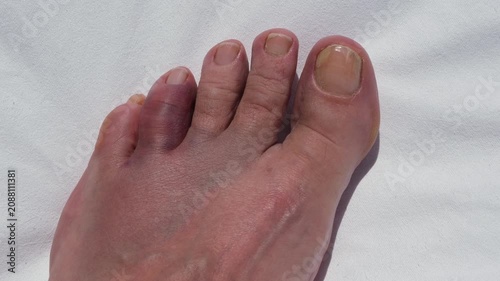 Swollen bruised toe after accidental impact with a rock, concept of foot injury, accident, first aid, healthcare and recovery.