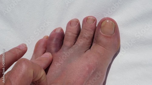 Bruised and swollen toe after hitting a rock, concept of foot injury, pain, trauma, healthcare and recovery.