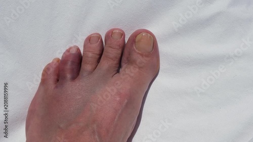 Bruised and swollen toe after hitting a rock, concept of foot injury, pain, trauma, healthcare and recovery.