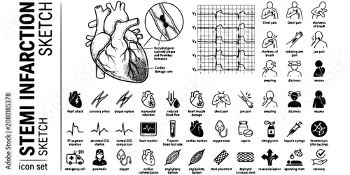 Konstfotografi STEMI Myocardial Infarction Sketch Black White-Coronary Occlusion ST Elevation D