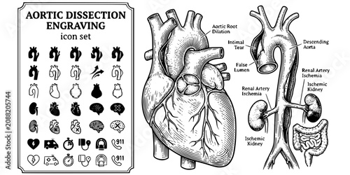 Canvastavla Aortic Dissection Engraving Black White-Root Dilation Flap Ischaemia Plane-Emerg