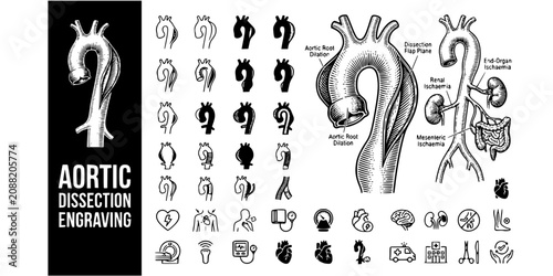 Canvastavla Aortic Dissection Engraving Black White-Root Dilation Flap Ischaemia Plane-Emerg