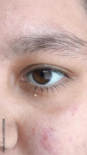 milia on facial skin near eye, skincare routine, dermatology and cosmetic treatment concept.
