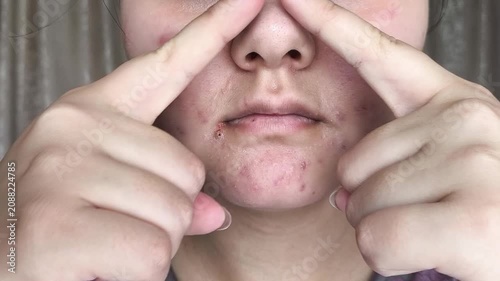 Close up of woman indicating acne-prone area on face, facial skincare, dermatology and healthy skin concept. problematic skin, skincare routine and dermatology awareness concept.