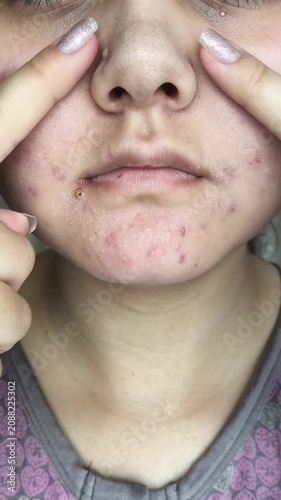 Close up of woman indicating acne-prone area on face, facial skincare, dermatology and healthy skin concept. problematic skin, skincare routine and dermatology awareness concept.