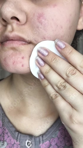 Young woman cleansing oily facial skin with cotton pad, daily skincare routine, facial cleansing and beauty concept.