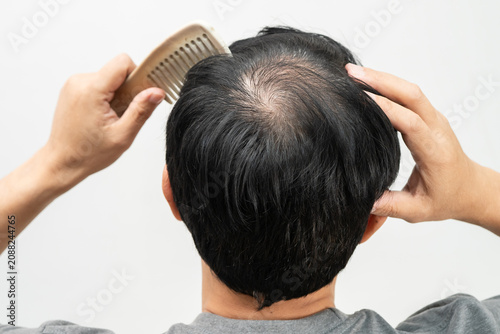 Принти на полотні Bald in the middle head and begin no loss hair glabrous of mature man