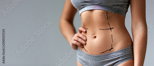 Abdômen feminino com marcações cirúrgicas para lipoaspiração ou abdominoplastia. Conceito de cirurgia plástica e contorno corporal com espaço para texto