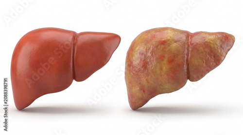 Comparison of healthy and fatty diseased human liver anatomy isolated on white background showing cirrhosis and steatosis effects