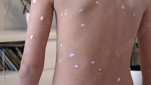 Back of child with chickenpox rash. Chickenpox treatment at home. 7 years old child with rash from chickenpox and with antiseptic on skin. Child suffers from chickenpox.
