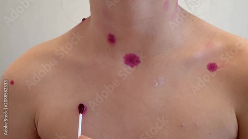 Mother applies chickenpox remedy on body of her child. Chickenpox treatment at home. 7 years old child with chickenpox. Mom lubricates rash from chickenpox with antiseptic using cotton bud.