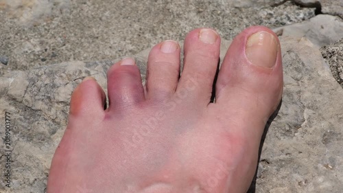 A swollen and bruised toe after accidentally hitting a rock on a beach vacation. Foot injury concept, accident, first aid, healthcare, and recovery.