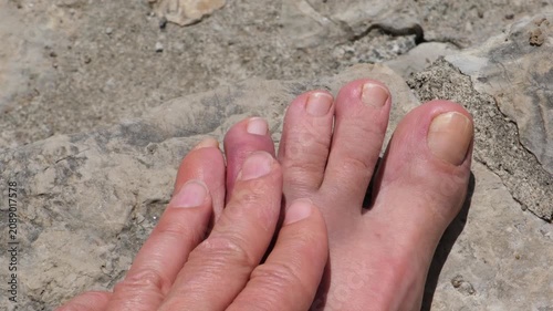 A swollen and bruised toe after accidentally hitting a rock on a beach vacation. Foot injury concept, accident, first aid, healthcare, and recovery.