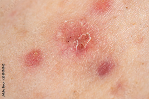 Obraz na plátně Blemishes with redness on skin