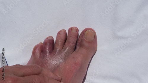 Applying pain relief ointment to an injured swollen toe after hitting a rock during a seaside vacation, concept of first aid, healthcare and recovery.