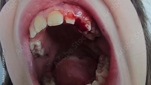Child shows dental condition with visible cavities and gum issues in a clinical setting during an oral examination