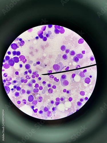 Bone Marrow Aspirate Smear Under Microscope.