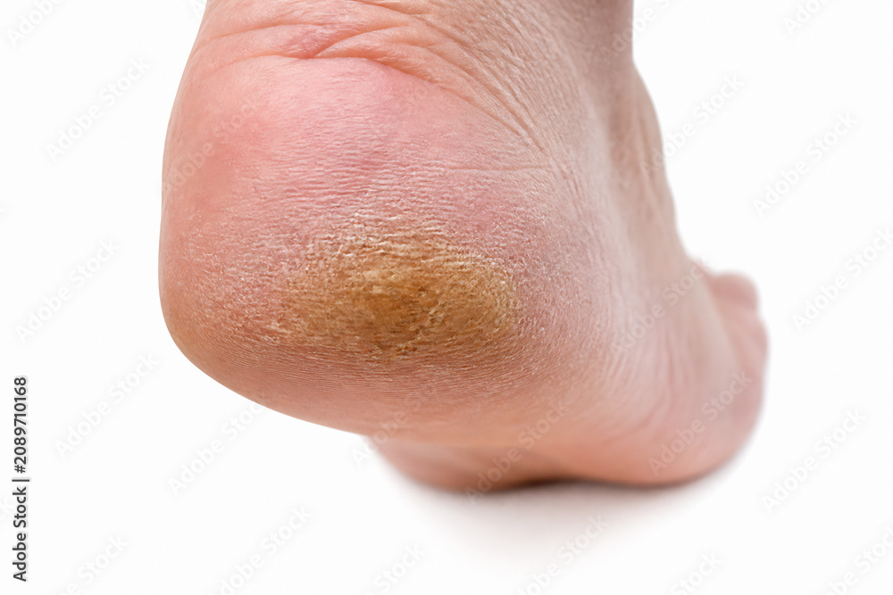 Fototapeta premium A close-up of a human foot with a patch of brown discoloration on the sole.
