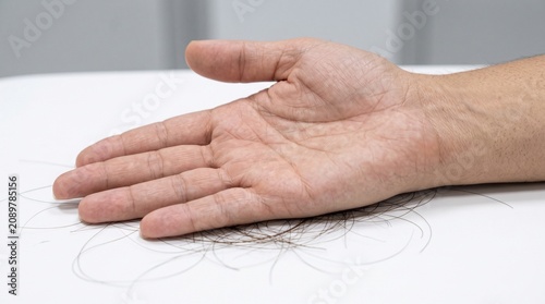 A close up top down view of a human hand resting on a white surface covered with many fallen dark brown strands of hair showing signs of significant hair loss.