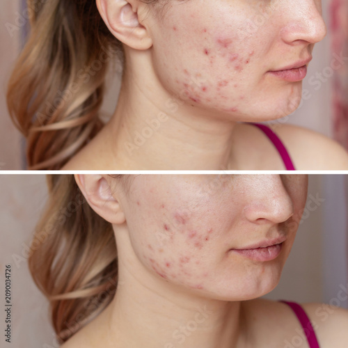 Collage of two close-up female cheek photos with acne inflammation, pimples and red blemishes, skincare and dermatology concept
