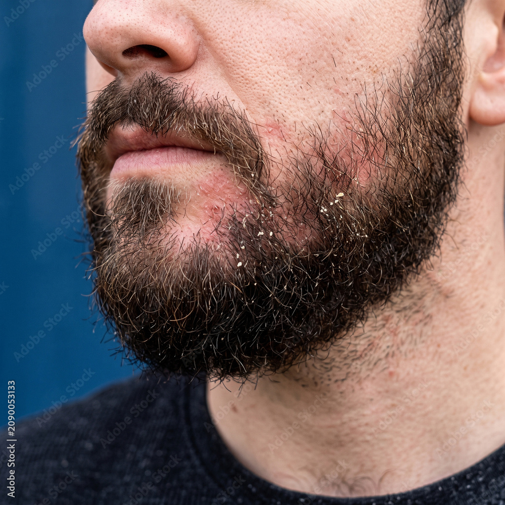 Fototapeta premium Beard of a man shows clear evidence of skin flaking and redness surrounding the chin and mouth area indicating a need for targeted skincare or professional dermatological treatment for skin health.