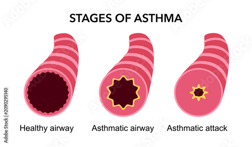 Bild auf Leinwand Stages of asthma medical condition in flat design vector illustration