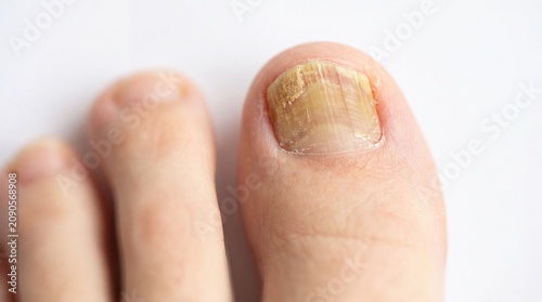 Close up of toenail fungus infection on human foot with discoloration and damage