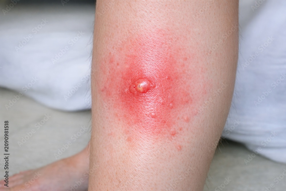 Fototapeta premium Close-up shot of a person's leg with a noticeable red spot, suitable for medical or educational contexts