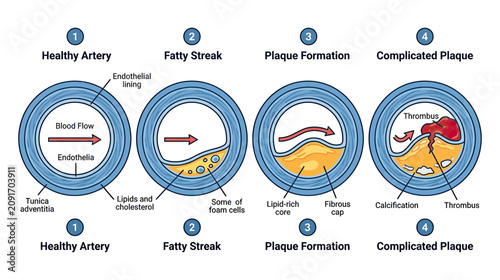 Bild auf Leinwand Atherosclerosis Progression: Healthy Artery to Complicated Plaque