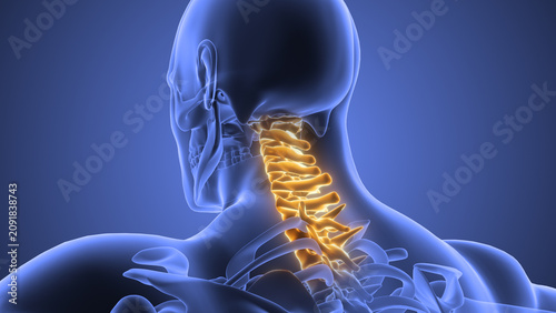 Cervical Spine Dysfunction Causing Chronic Neck Pain